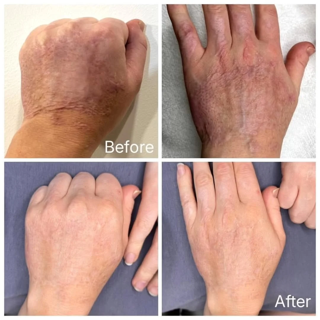 This isn&rsquo;t just a before-and-after.
This is someone getting a piece of their life back.

After a traumatic explosion, she was told: creams and time. That&rsquo;s it.

Then she found Aerolase, and everything changed. Using a customized protocol 