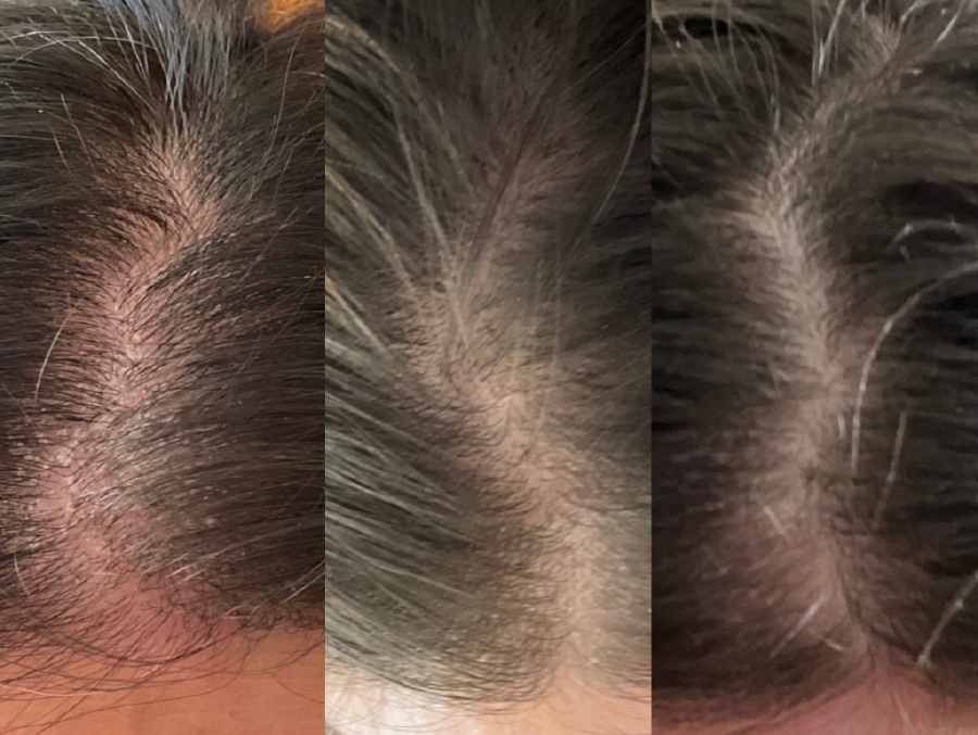 Close-up photos of hair and scalp with thinning hair and visible scalp areas
