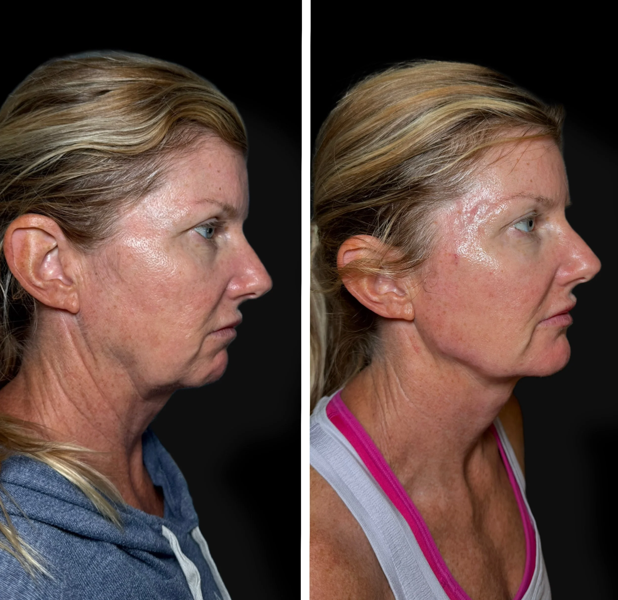 Side-by-side comparison of a middle-aged woman before and after skincare or cosmetic treatment, showing reduced wrinkles and improved skin texture.