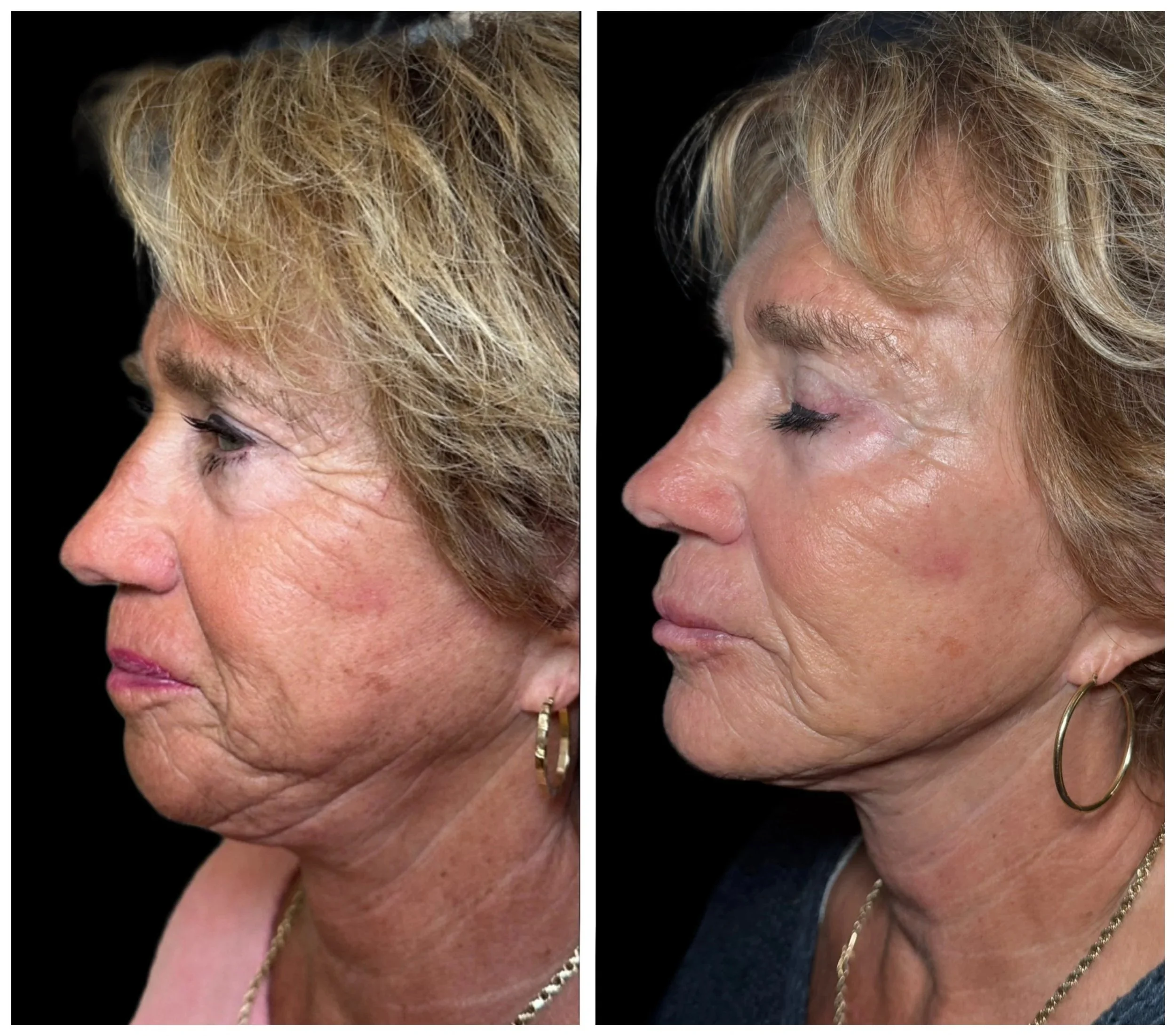 Side-by-side comparison of a woman before and after skin treatment, showing improved skin appearance and texture.