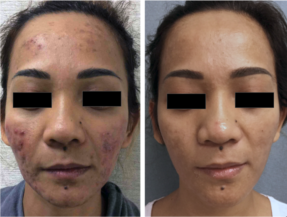 Side-by-side comparison of a woman’s face before and after skincare treatment. The left image shows her with severe acne and skin blemishes, while the right image shows clear, smooth skin.