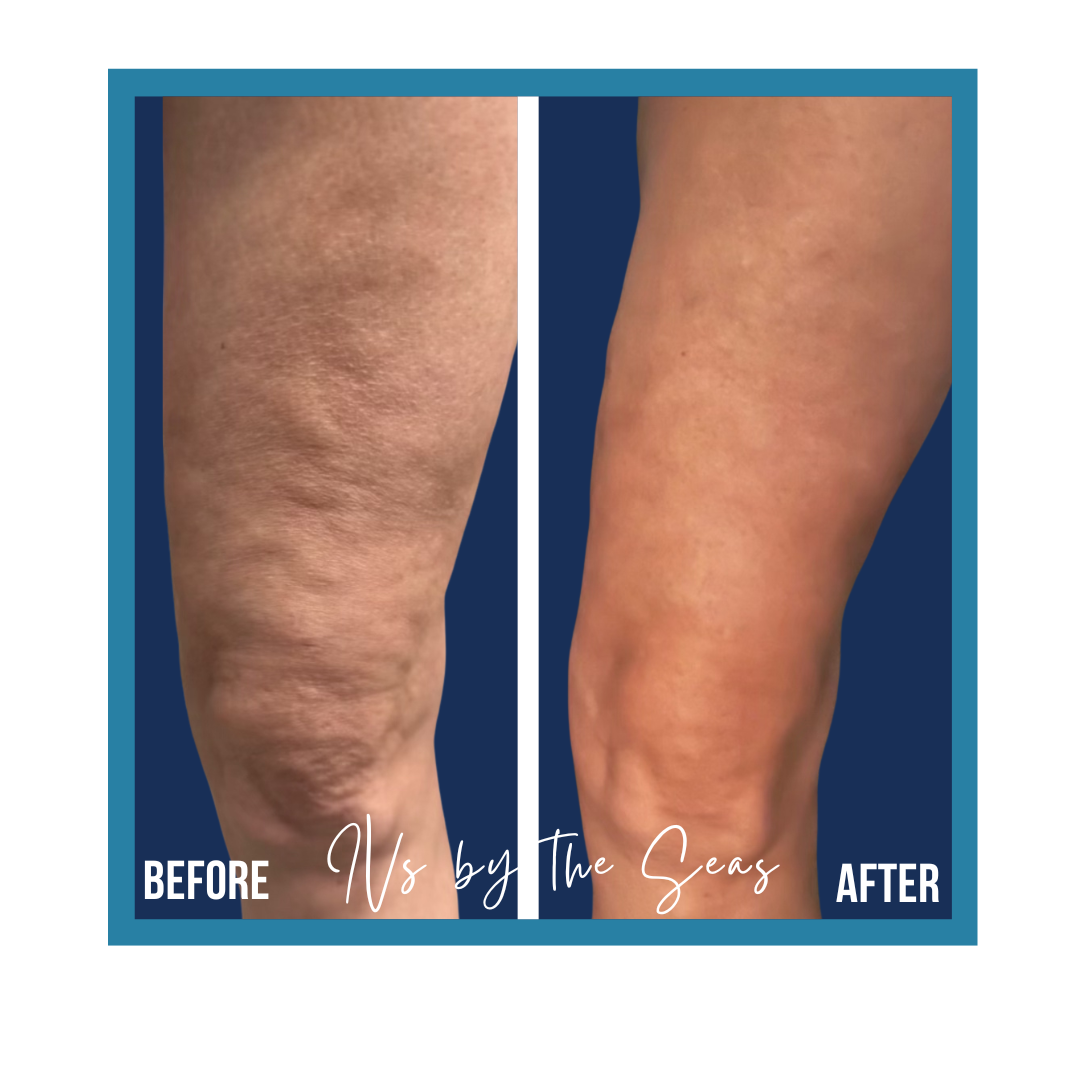 Cellulite Smoothing