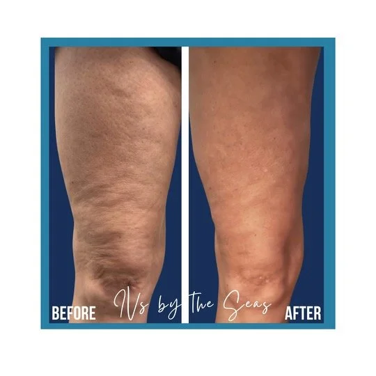 Cellulite Smoothing