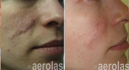 Scar Reduction