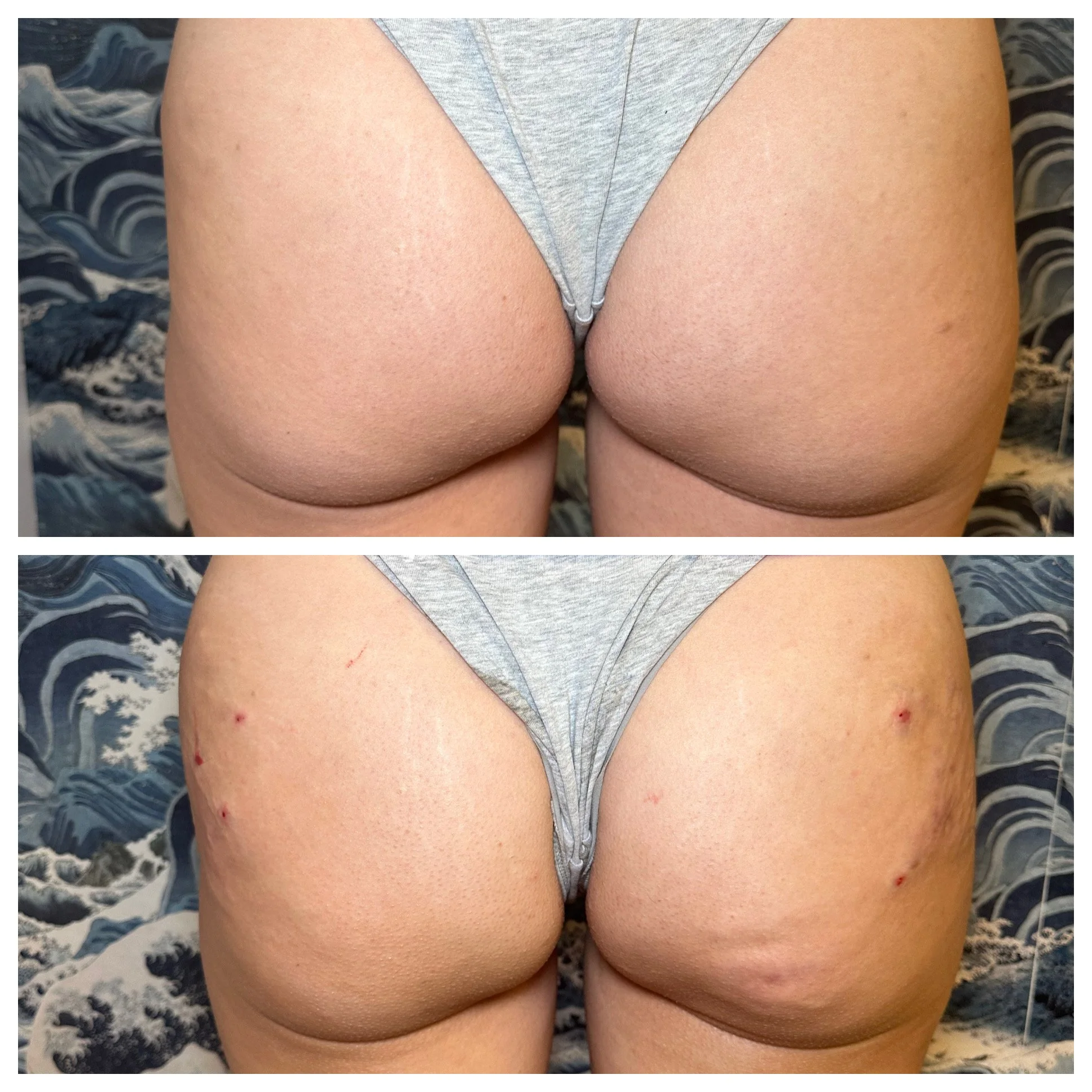 Patient 1- Third Treatment