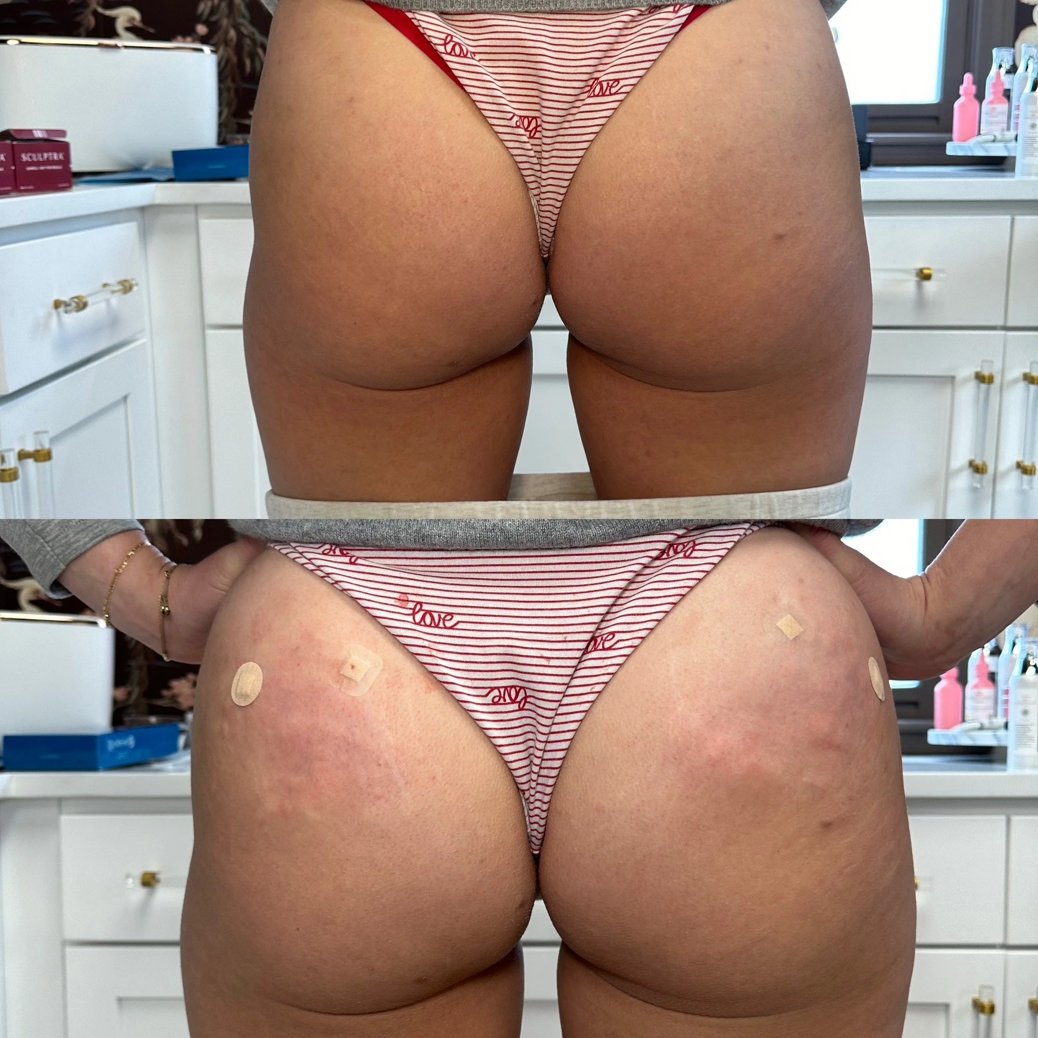 Patient 1- Second Treatment