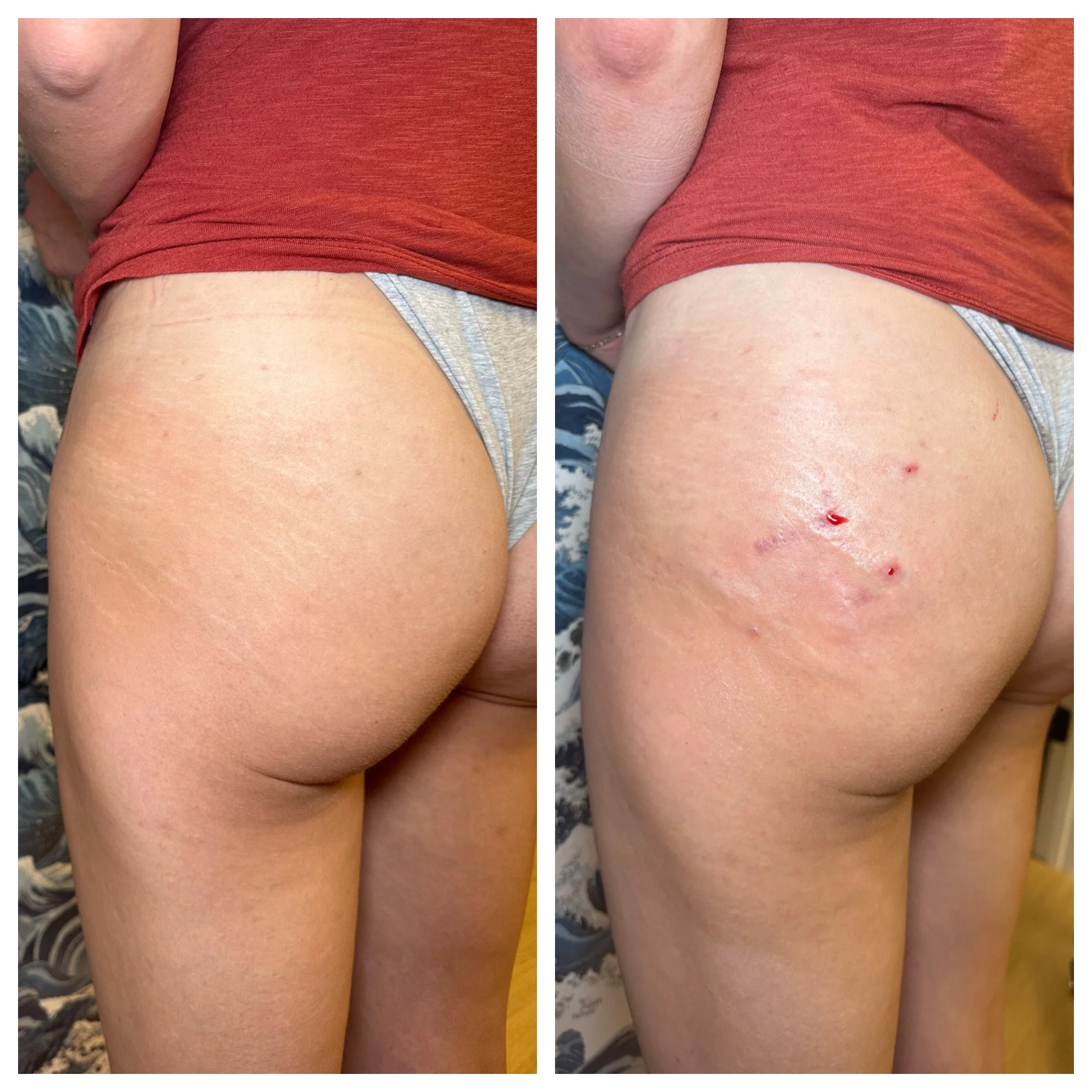 Patient 1- Third Treatment