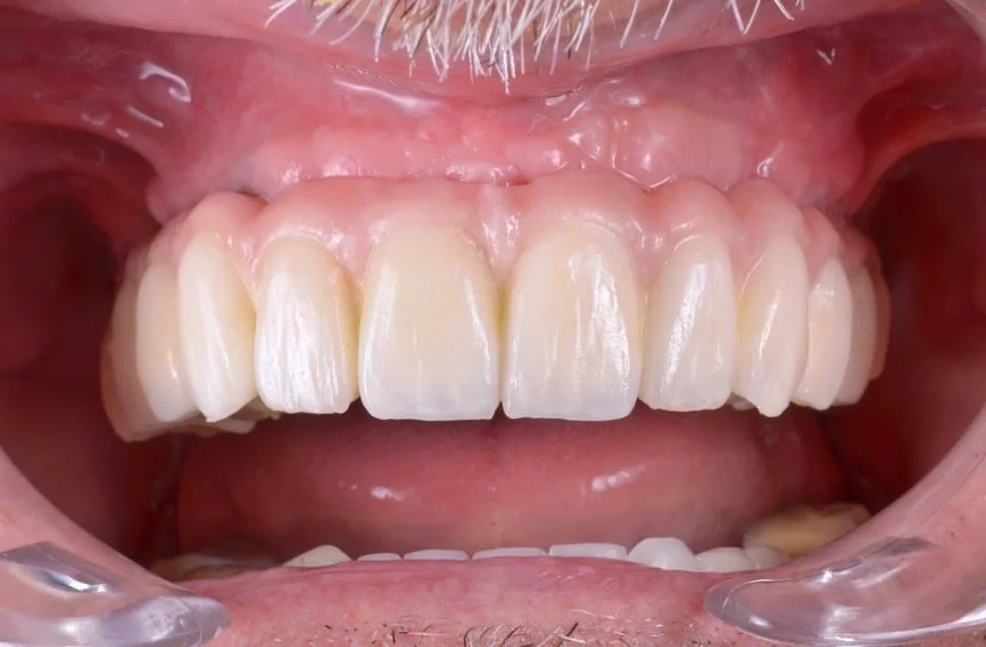 Dental Office in Tijuana — All on 4, Dental Implants, CAD/CAM