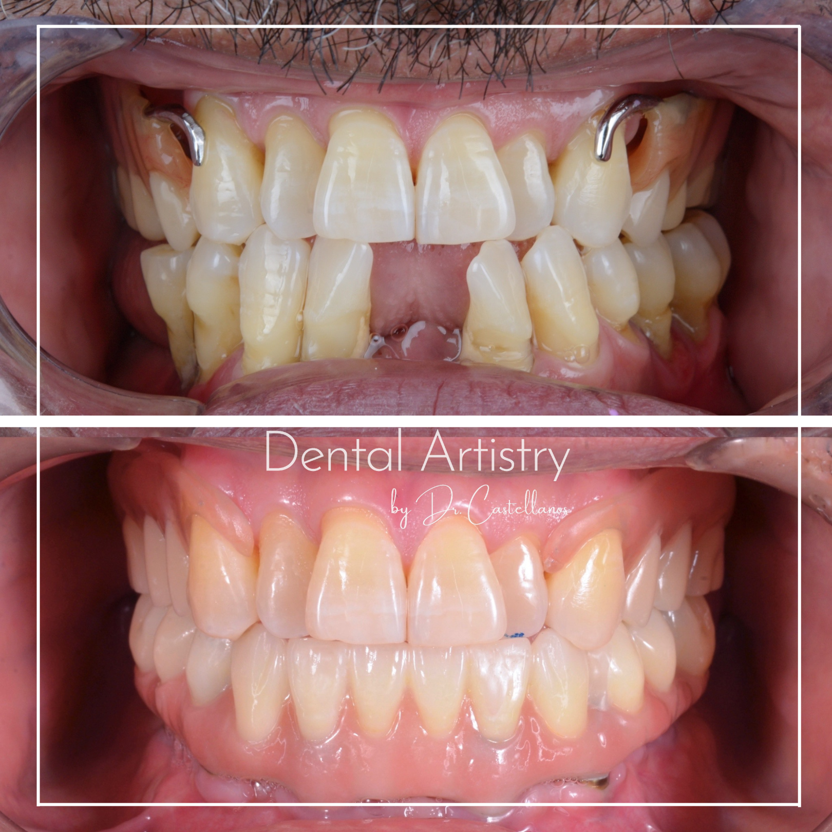 Before and after dental transformation showcasing significant improvement in teeth alignment and appearance.