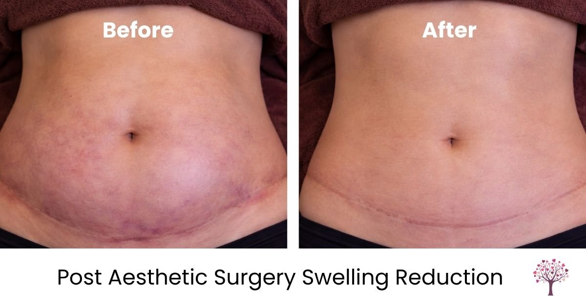 lymphatic massage for cosmetic surgery