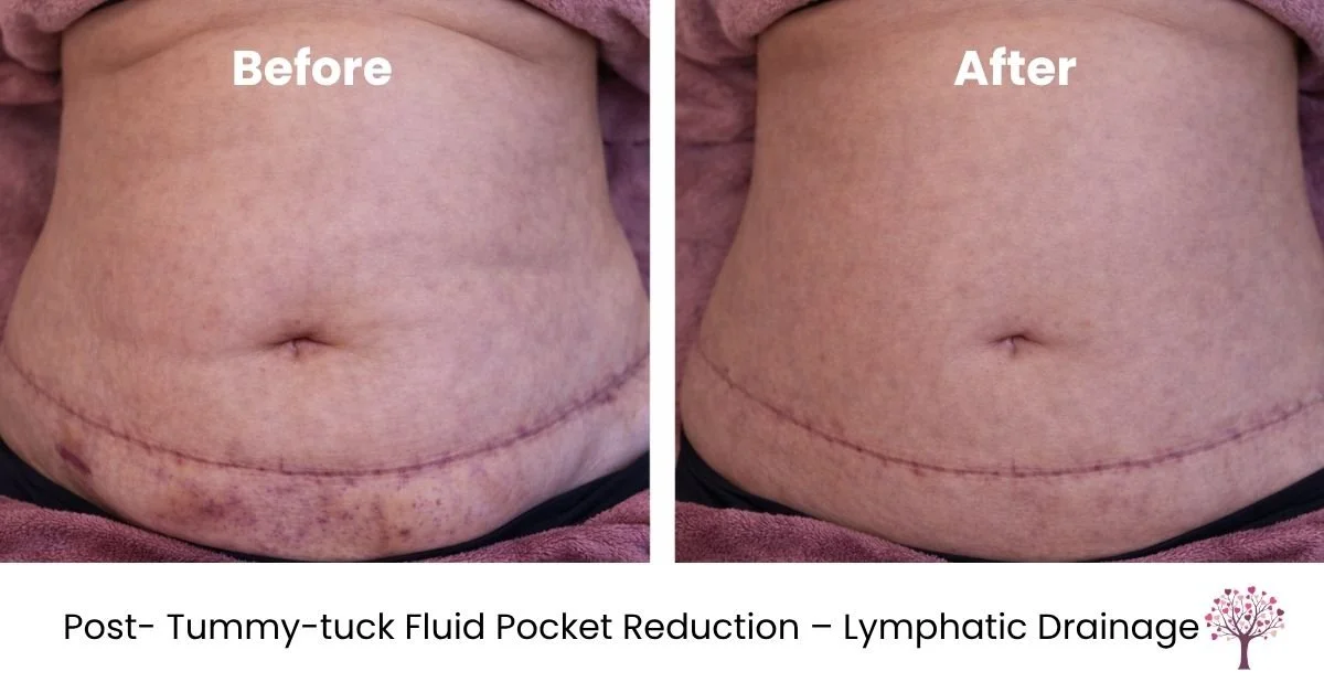 swelling redution lymphatic massage