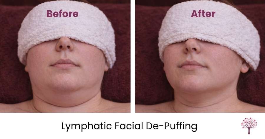 lymphatic facil for puffy face