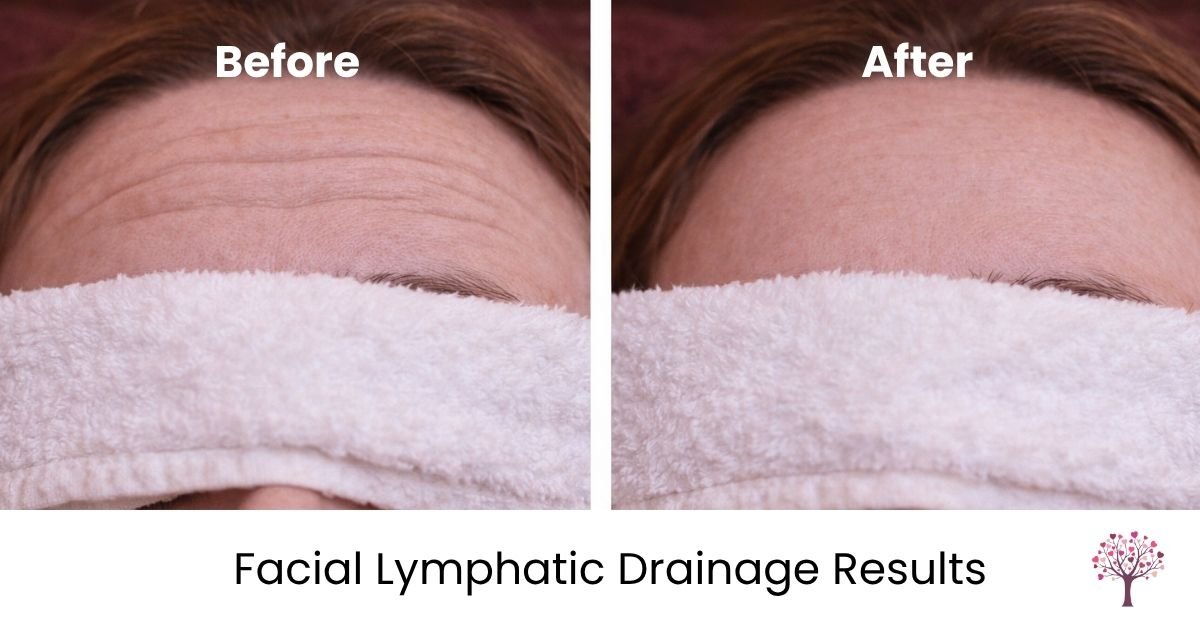 wrinkles reduction lymphatic massage