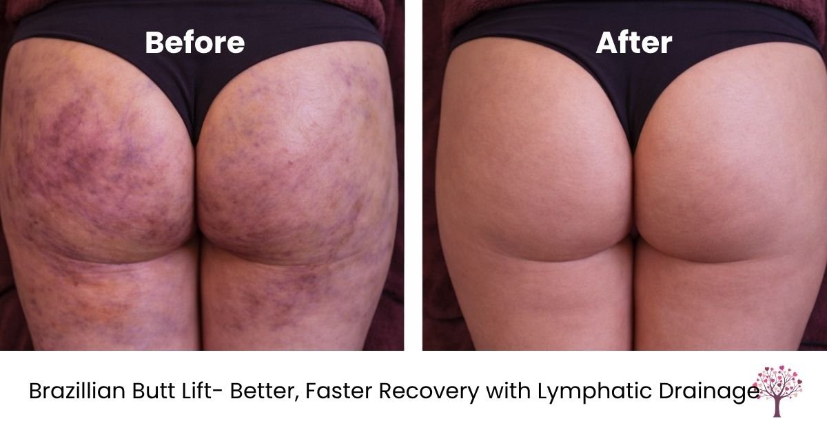 brazillian butt lift lymphatic drainage