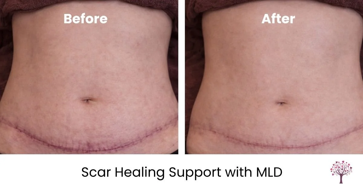 lymphatic massage for tscar healing