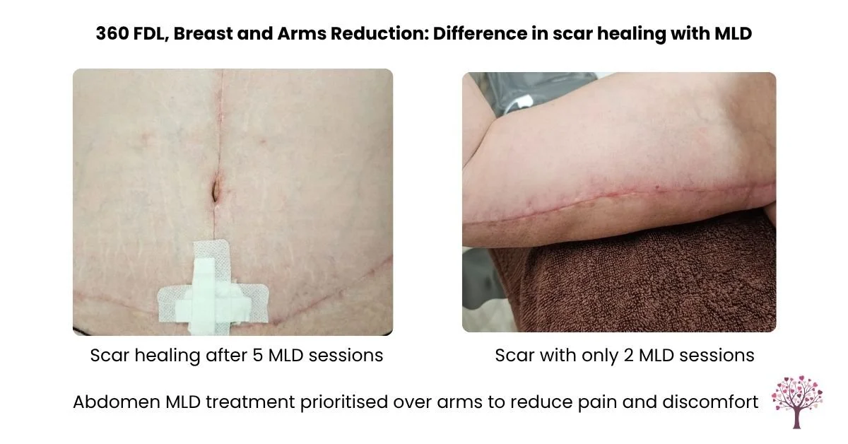 Lymphatic massage for breast surgery 360 FDL scar healing