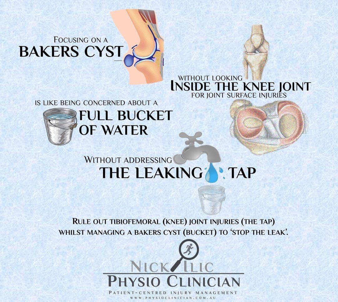 Repost from @nickilicphysio 

🦵Bakers Cysts🦵

Although a Bakers Cyst may be a cause of pain or &quot;tightness&quot; at the back of the knee it's important to find out where the fluid is coming from. Often it's from an ongoing issue *inside* the kn