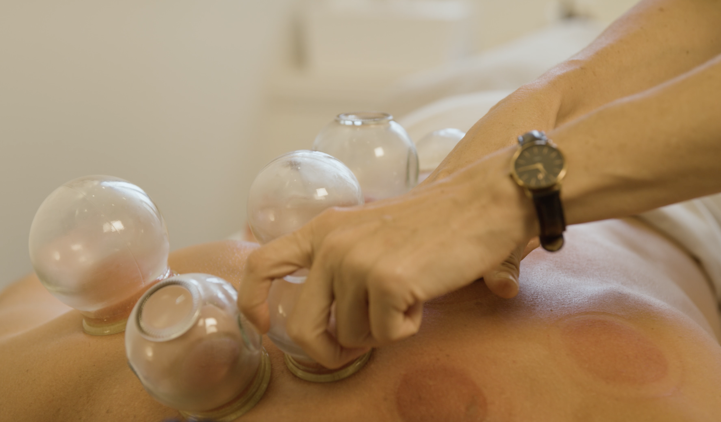 The Surprising Benefits of Cupping