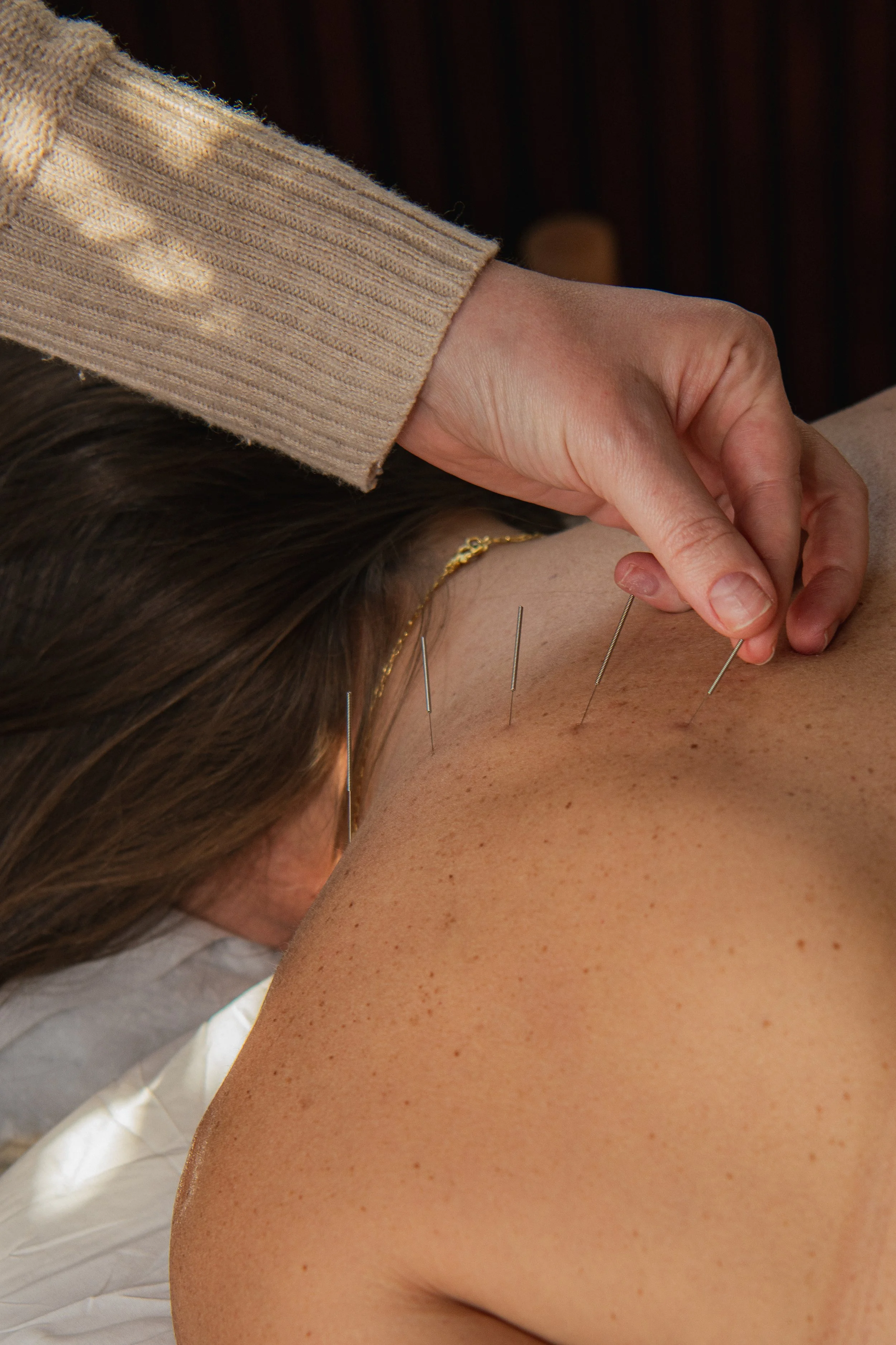 Acupuncture treatment session in Culver City using fine needles for natural healing