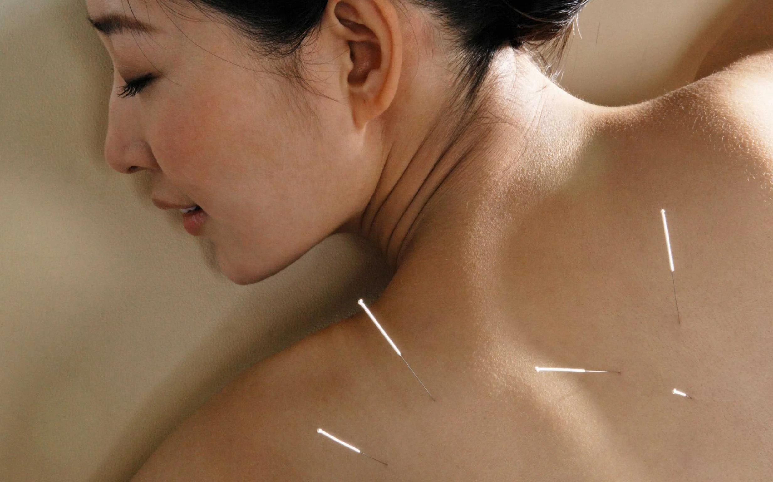 Acupuncture treatment session at an integrative medicine clinic in Culver City
