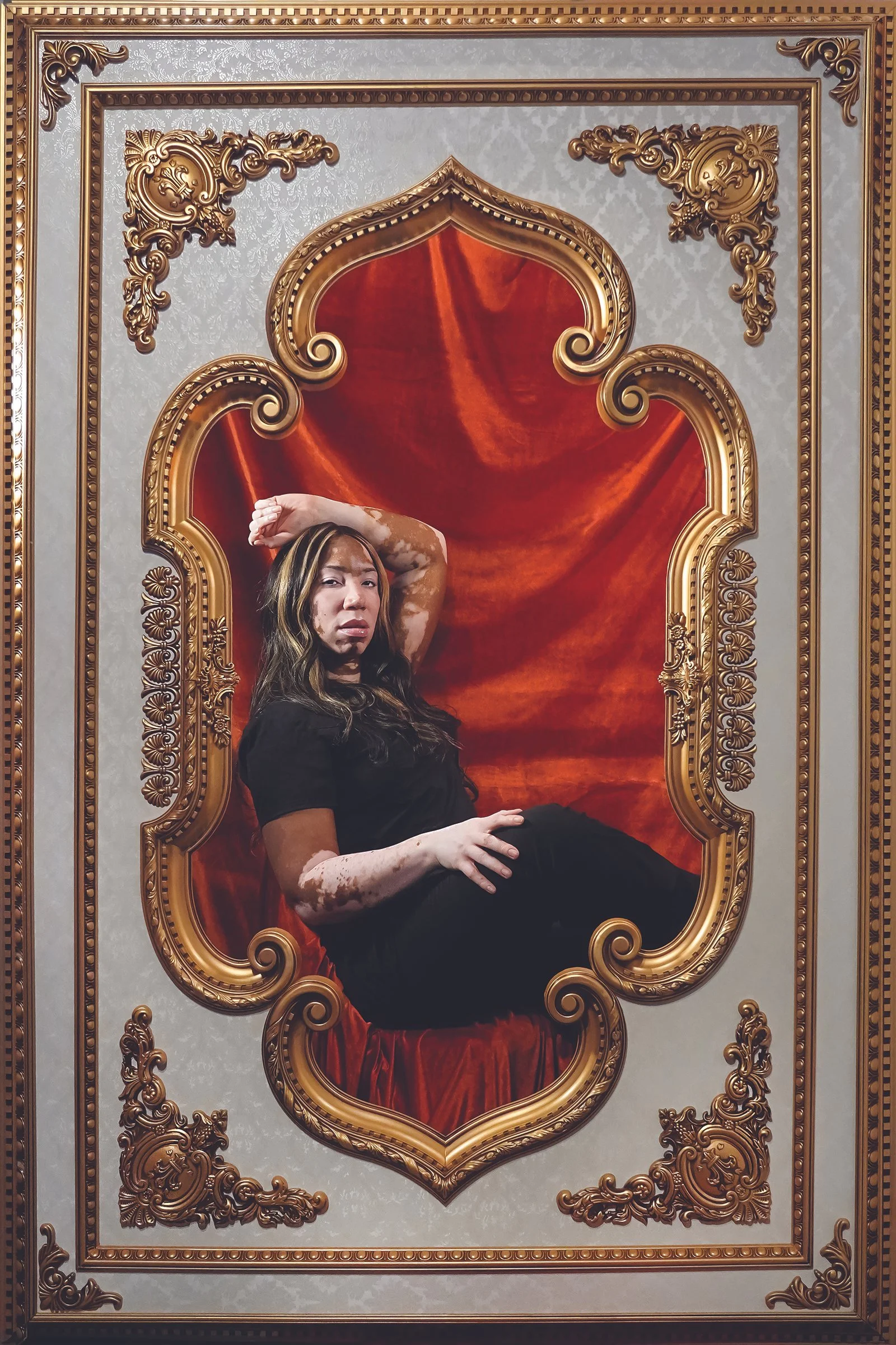 Carlene - VitiIigo: "I am a 35 year young Brooklynite and Vitiligo warrior. Vitiligo is a skin disorder which causes melanin loss in the skin, but in 'losing' melanin I found myself and a true purpose. Instead of it holding me back, my skin disorder 