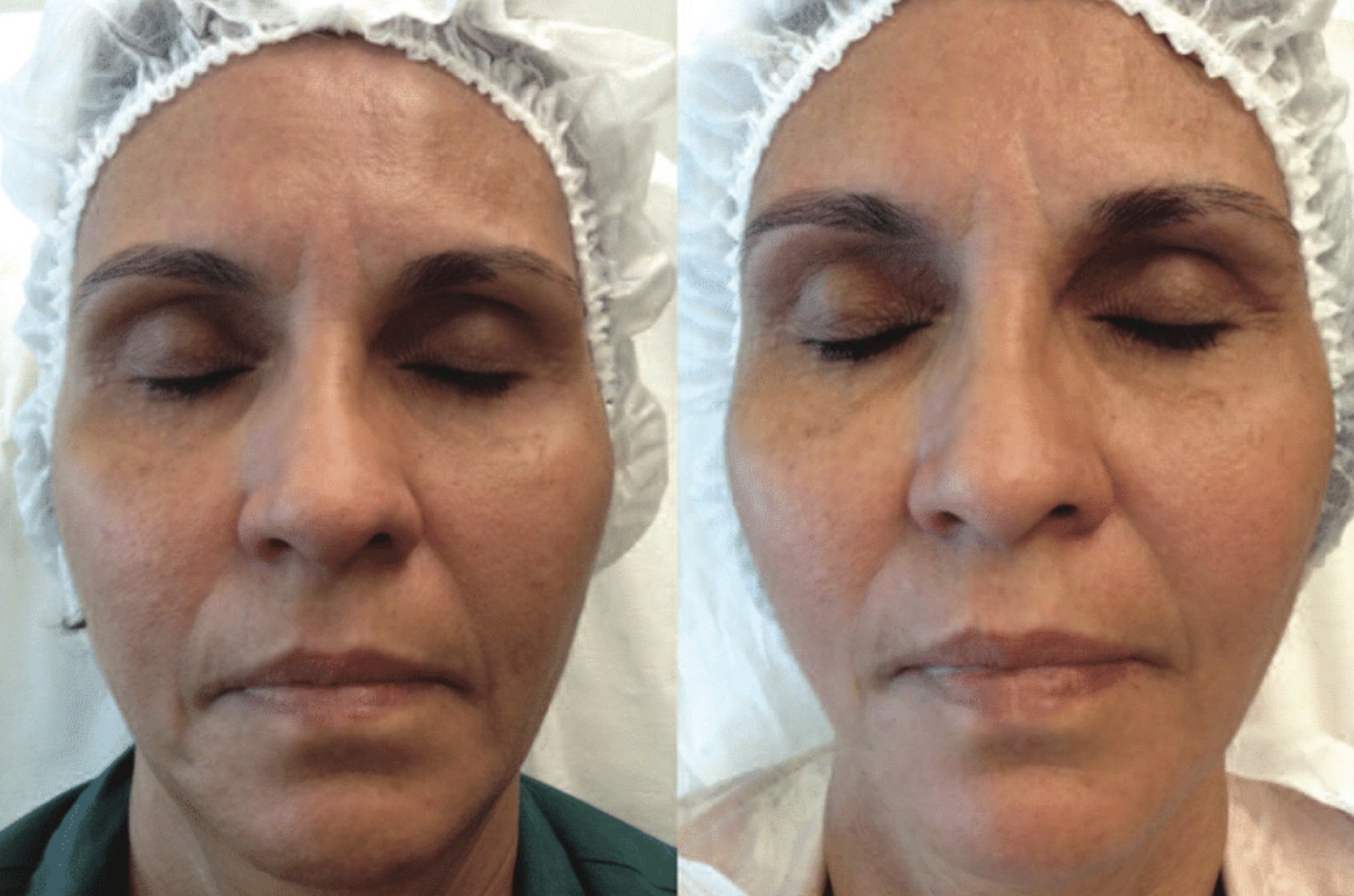 Before &amp; After ~ Hyaluronic Treatment (Periorbital)