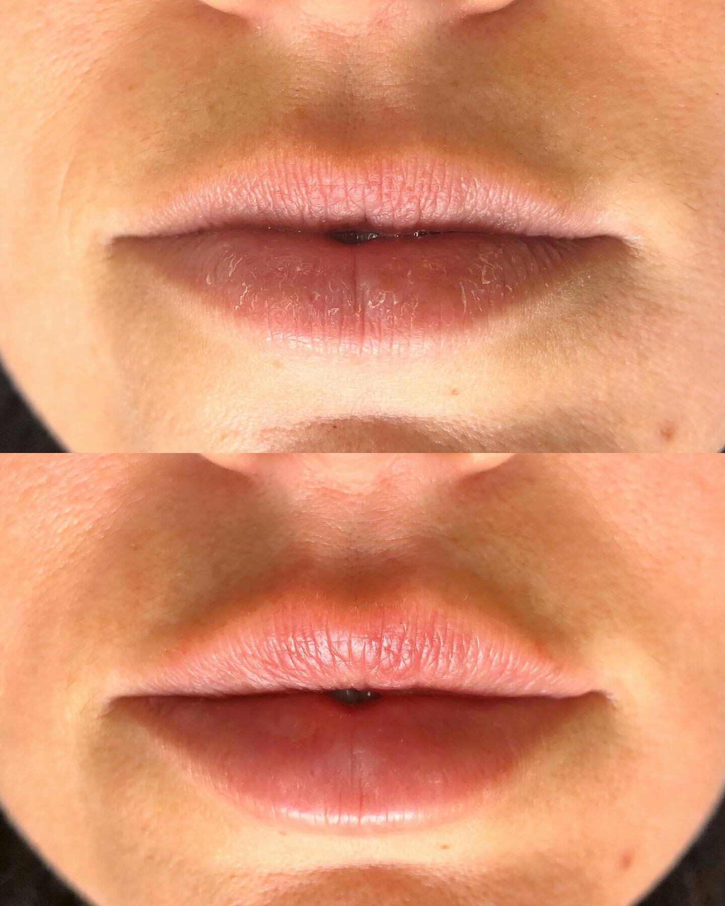Fewer filters 👏🏻 More fillers 👏🏻 Obsessed with this natural before and after lip enhancement 😍💕 *chef&rsquo;s kiss*