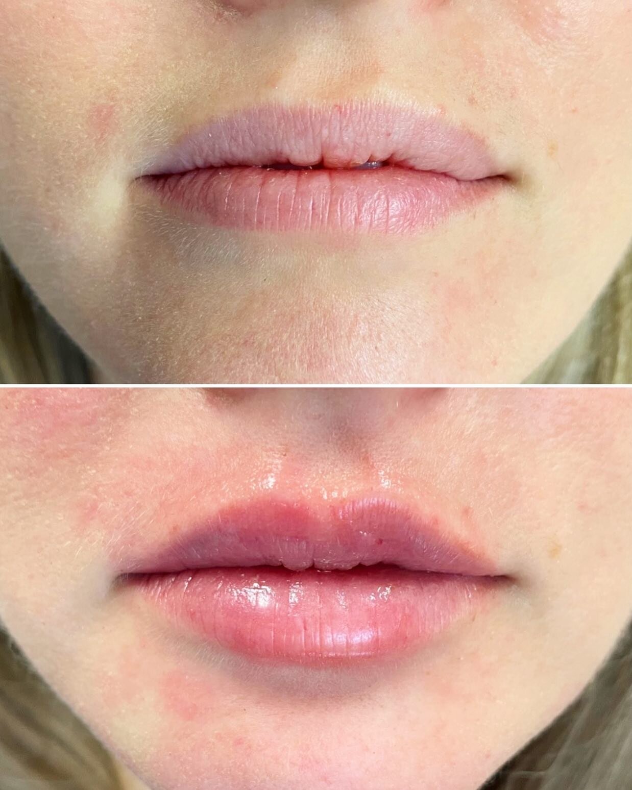Before and After
We used 1 syringe of Juvederm Volbella in the upper and lower lips. She looks so good! 😍