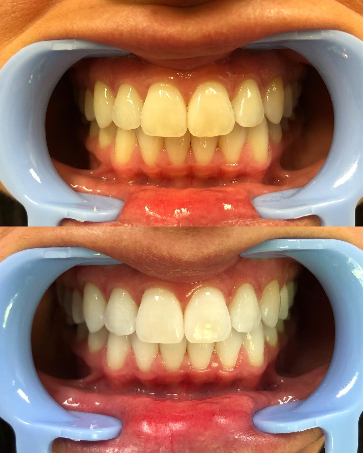 On Wednesdays we whiten 🦷⚡️
.
.
We now offer two ways to professionally bleach your teeth! We&rsquo;ve always offered custom bleach trays you can take home &amp; use on your time...but NOW...we offer in-office whitening too! Check out these results 