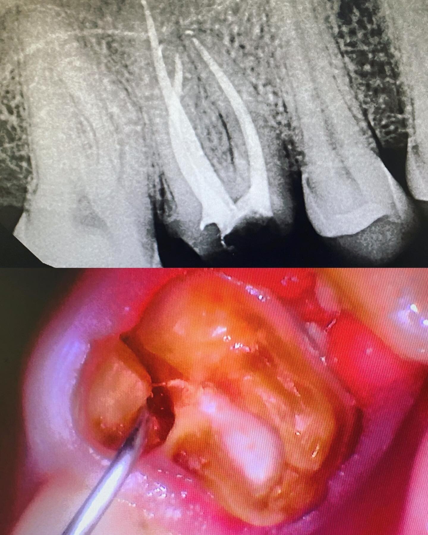 Patient education is our top priority. Sometimes, it&rsquo;s hard to understand an x-ray. This is a great example! Cracks typically don&rsquo;t show up on x-rays. Can you see it in the top photo? Now how about the bottom one? 😬💕 We take intraoral p