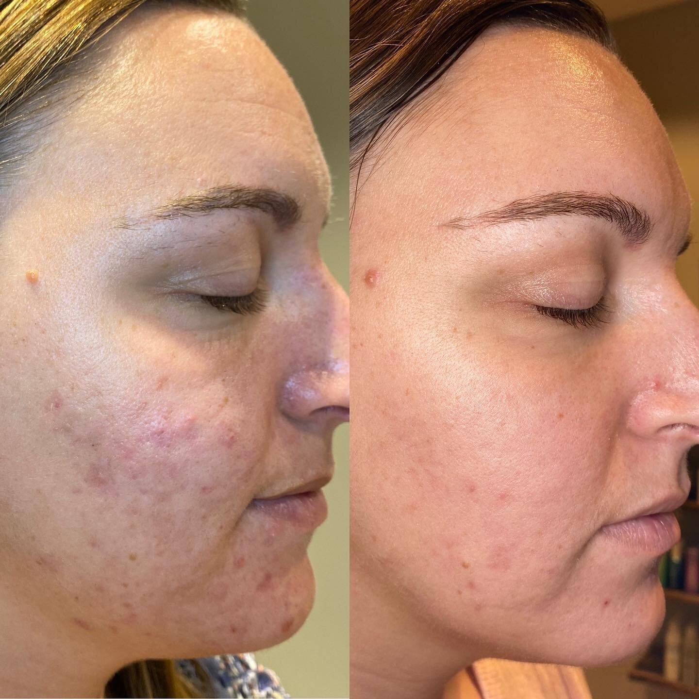 Nothing better than starting the week of with some amazing before and afters. We have been able to clear up 90% of her active acne and scarring with 4 rounds of the ProPeel + an at home skincare routine that includes mandelic acid and benzoyl peroxid