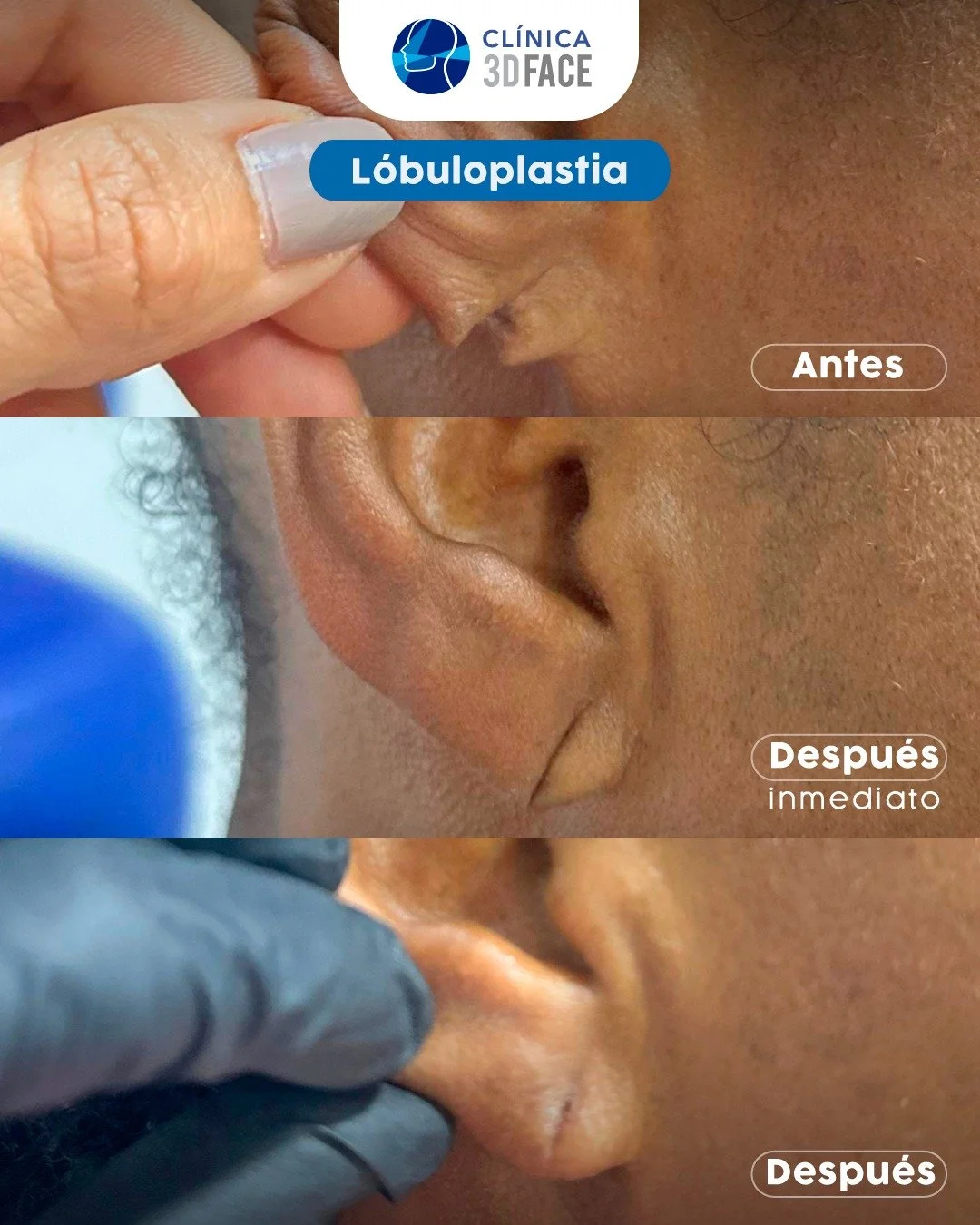 Lobuloplastia es una cirug&iacute;a menor ambulatoria, realizada con anestesia local que mediante una peque&ntilde;a incisi&oacute;n corrige, repara o da forma a los l&oacute;bulos de una o de las dos orejas del paciente. Despegar los l&oacute;bulos,