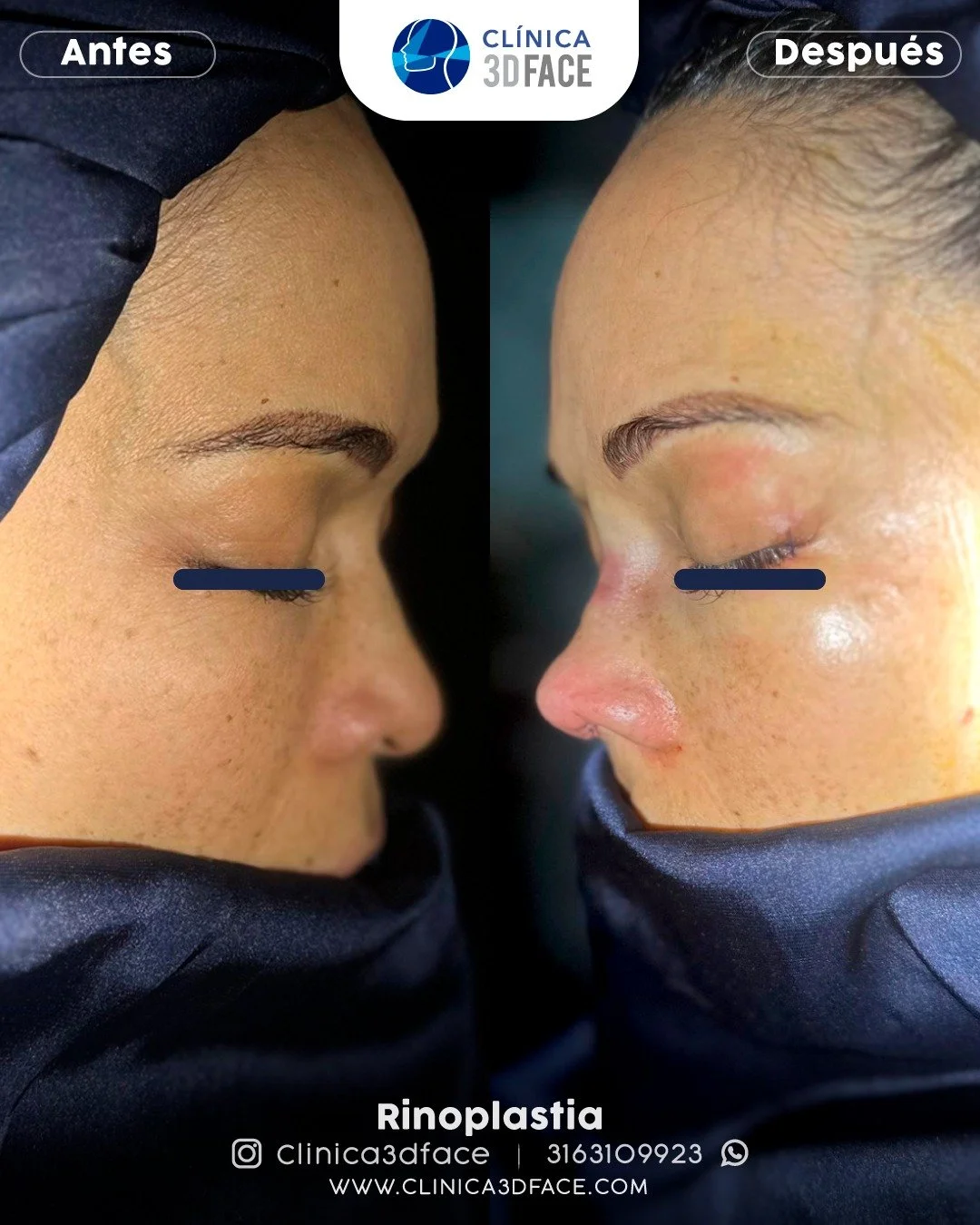 La rinoseptoplastia es una cirug&iacute;a que modifica la nariz tanto funcional como est&eacute;ticamente. Es realizada por otorrinolaring&oacute;logos y puede abordar problemas obstructivos, deformidades cong&eacute;nitas o traum&aacute;ticas. 

 👱