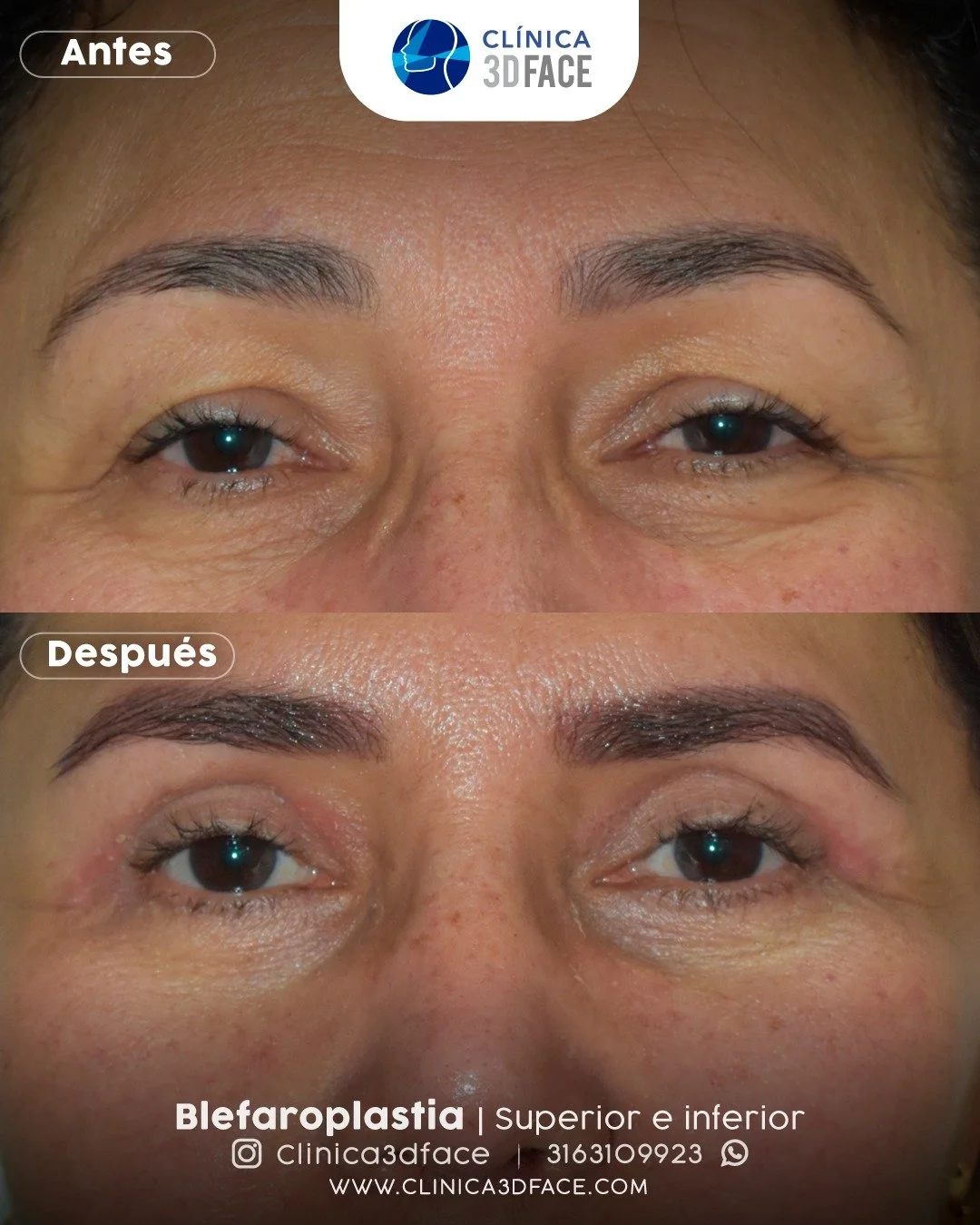 &iquest;Qu&eacute; tipos de blefaroplastia existen?

Superior: corrige p&aacute;rpados ca&iacute;dos (ptosis palpebral)
Inferior: elimina bolsas y ojeras
Combinada: superior + inferior en un solo procedimiento
Transconjuntival: sin cicatriz externa (
