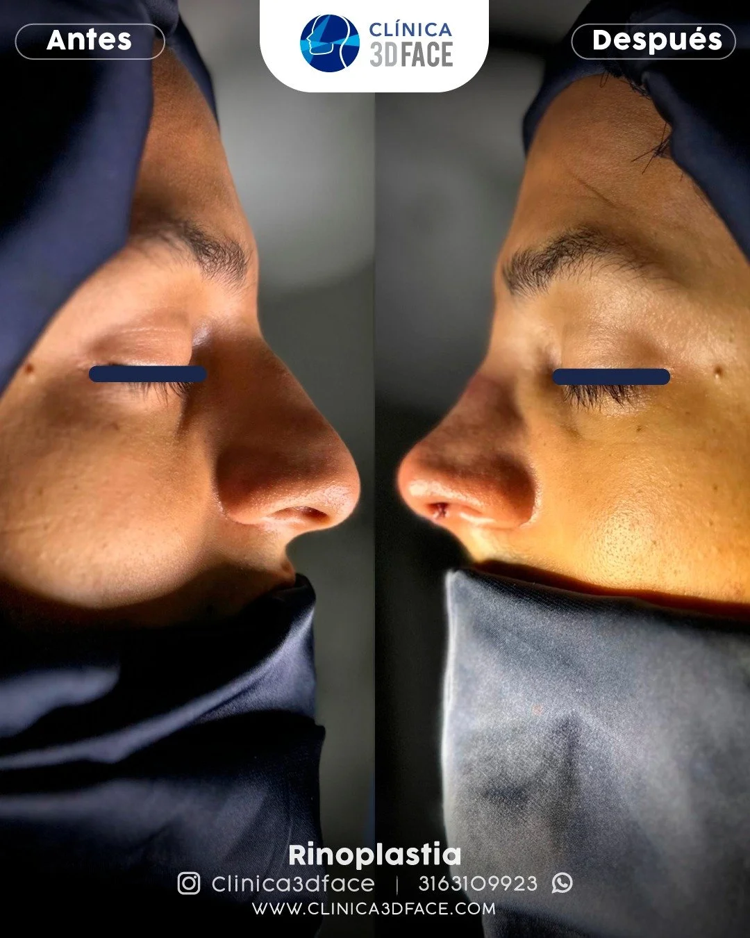 &iquest;Cu&aacute;nto cuesta una rinoplastia en Cali?

La rinoplastia es una de las cirug&iacute;as est&eacute;ticas m&aacute;s populares en Colombia, atrayendo a personas que buscan mejorar la forma y funci&oacute;n de su nariz. Si est&aacute;s cons