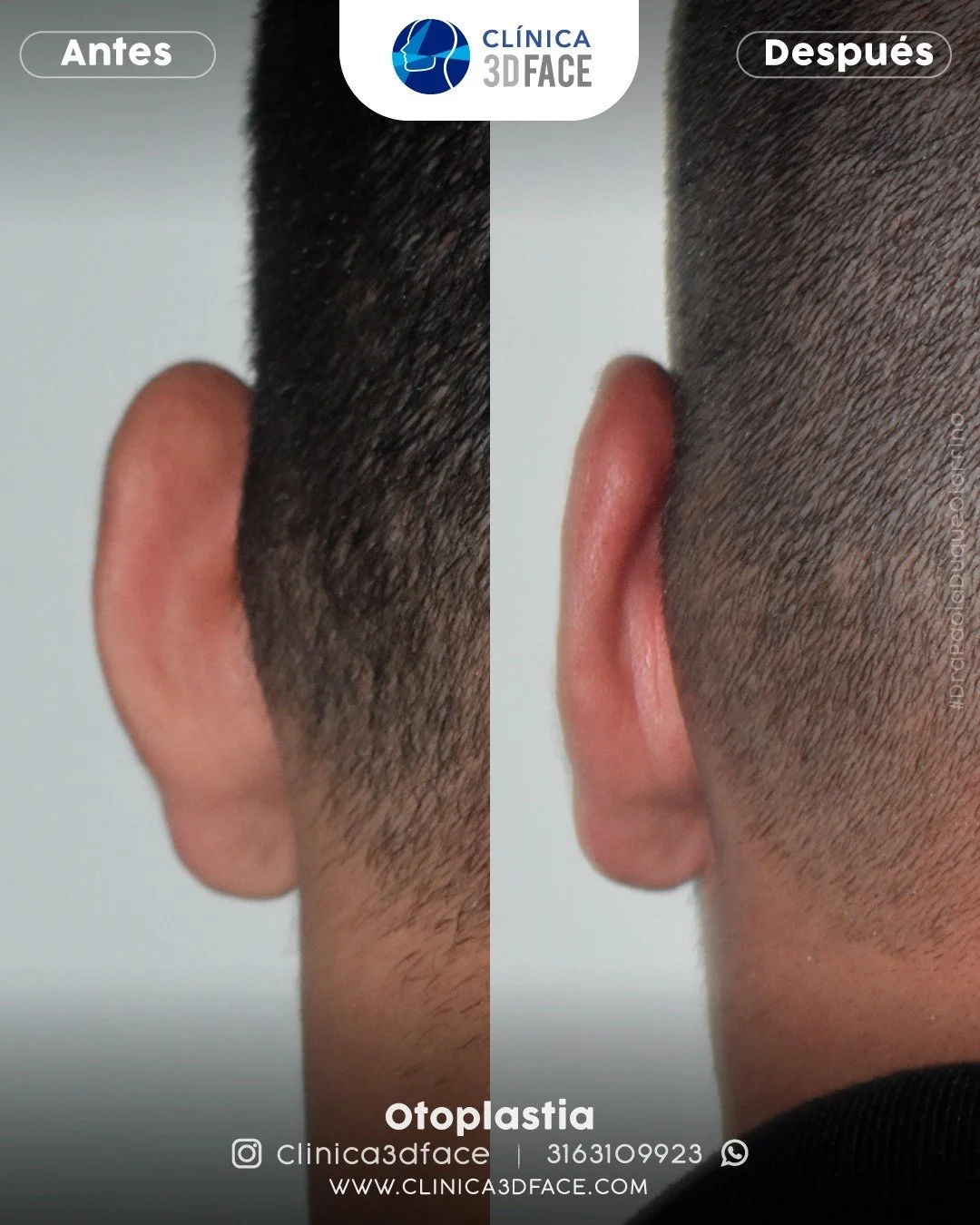 &iquest;A partir de qu&eacute; edad pueden operarse las orejas?

A partir de los 7-8 a&ntilde;os. A esta edad las orejas ya se han desarrollado y alcanzando pr&aacute;cticamente su tama&ntilde;o definitivo. 
.
👱&zwj;♀️🌸 Agenda tu valoraci&oacute;n 