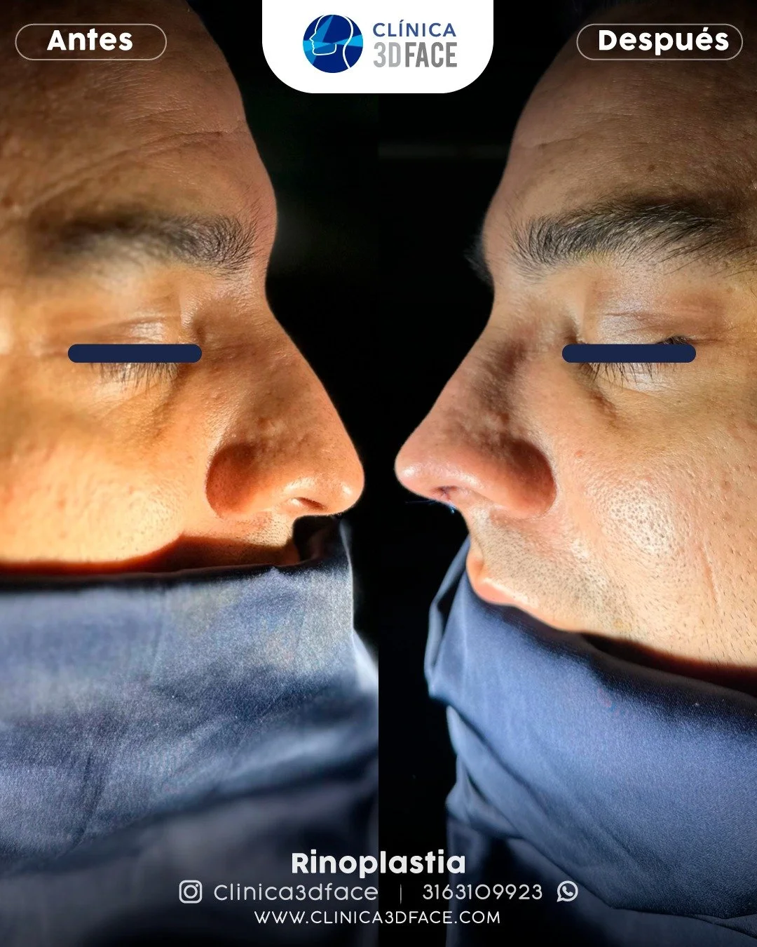 La nariz cuenta con una estructura la cual se puede modificar y cambiar de forma significativa en cada persona por lo que se conoce como el biotipo &eacute;tnico lo que nos indica que los asi&aacute;ticos y africanos tengan la nariz muy diferente a e