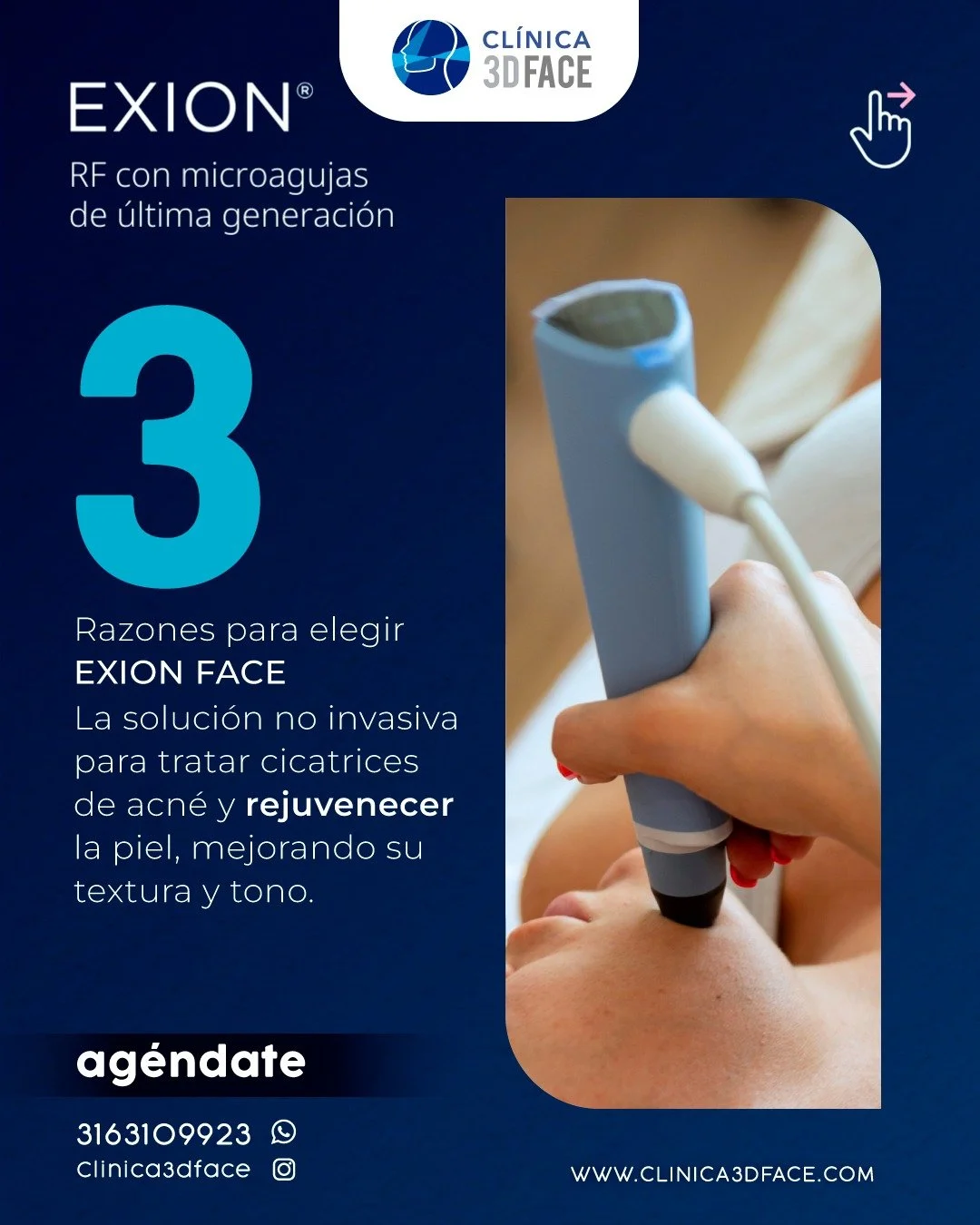 EXION es una plataforma est&eacute;tica avanzada, que utilizamos para tratar cicatrices de acn&eacute;, combinando radiofrecuencia, microablaci&oacute;n y ultrasonido para mejorar la textura y tono de la piel, reducir cicatrices y otros problemas com