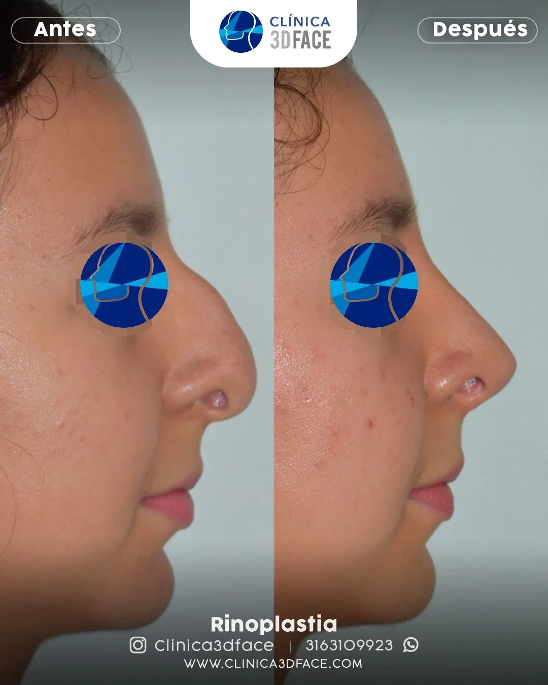 Rinoseptoplastia: Una cirug&iacute;a de doble beneficio

La rinoseptoplastia es una cirug&iacute;a que modifica la nariz tanto funcional como est&eacute;ticamente. Es realizada por otorrinolaring&oacute;logos y puede abordar problemas obstructivos, d