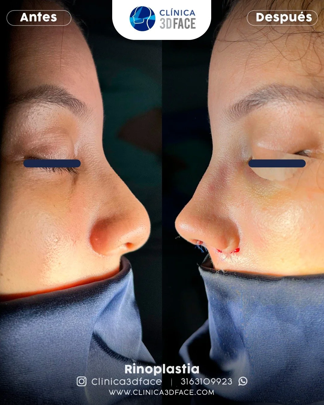 La rinoplastia secundaria o segunda operaci&oacute;n de nariz

Es la cirug&iacute;a que solicita un paciente para mejorar la forma o funci&oacute;n de la nariz despu&eacute;s de una primera rinoplastia en la que no se ha conseguido un buen resultado 