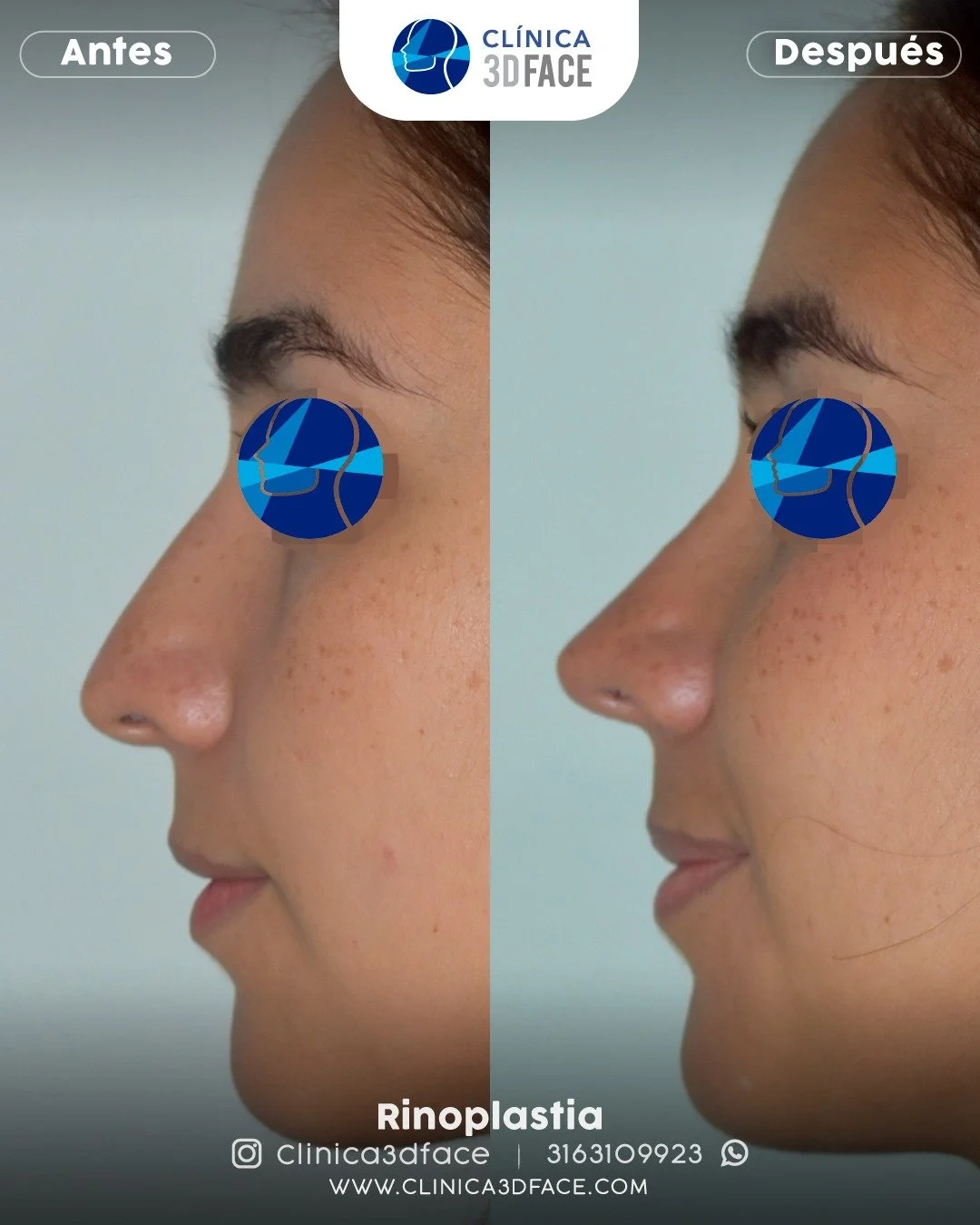 Una paciente con rostro arm&oacute;nico que quiso un cambio natural y femenino.

&iquest;Qu&eacute; es la rinoplastia ultras&oacute;nica en Cali?
La rinoplastia ultras&oacute;nica es un termino que se viene utilizando desde hace ya varios a&ntilde;os