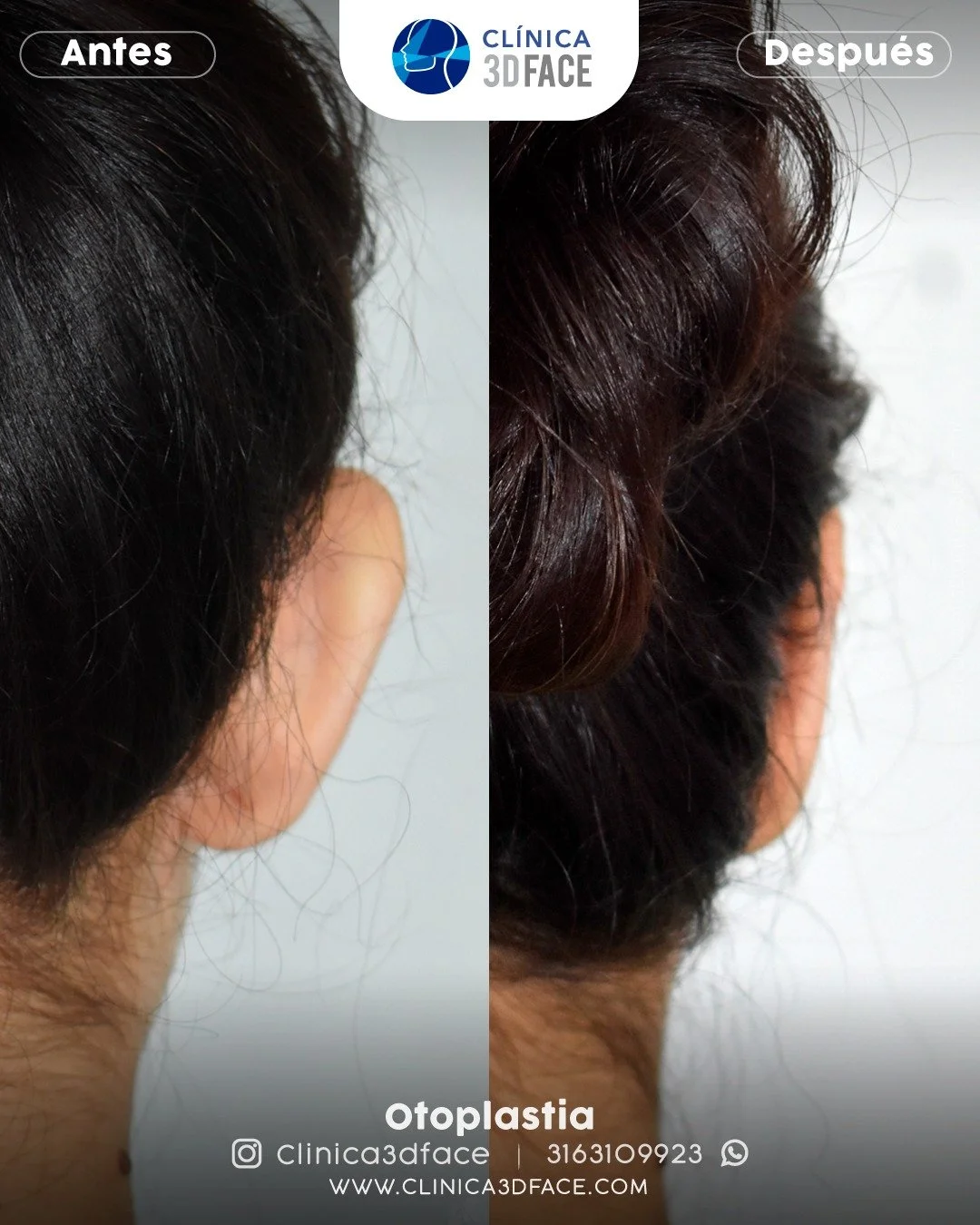 &iquest;Orejas grandes? Existe una soluci&oacute;n.

Muchas personas no viven a gusto con la forma o tama&ntilde;o de sus orejas. Y esta situacion casi siempre se presenta desde la infancia, cuando los ni&ntilde;os utilizan la forma de las orejas par