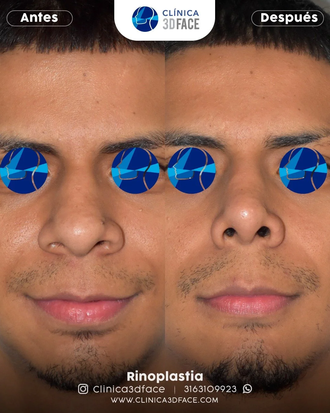 &iquest;Qu&eacute; es la alectomia nasal? &iquest;Qui&eacute;n es candidato para esta cirug&iacute;a?

Es una cirug&iacute;a que reduce o modifica el tama&ntilde;o de las alas nasales (aletas de la nariz) para mejorar la armon&iacute;a facial. Se enf