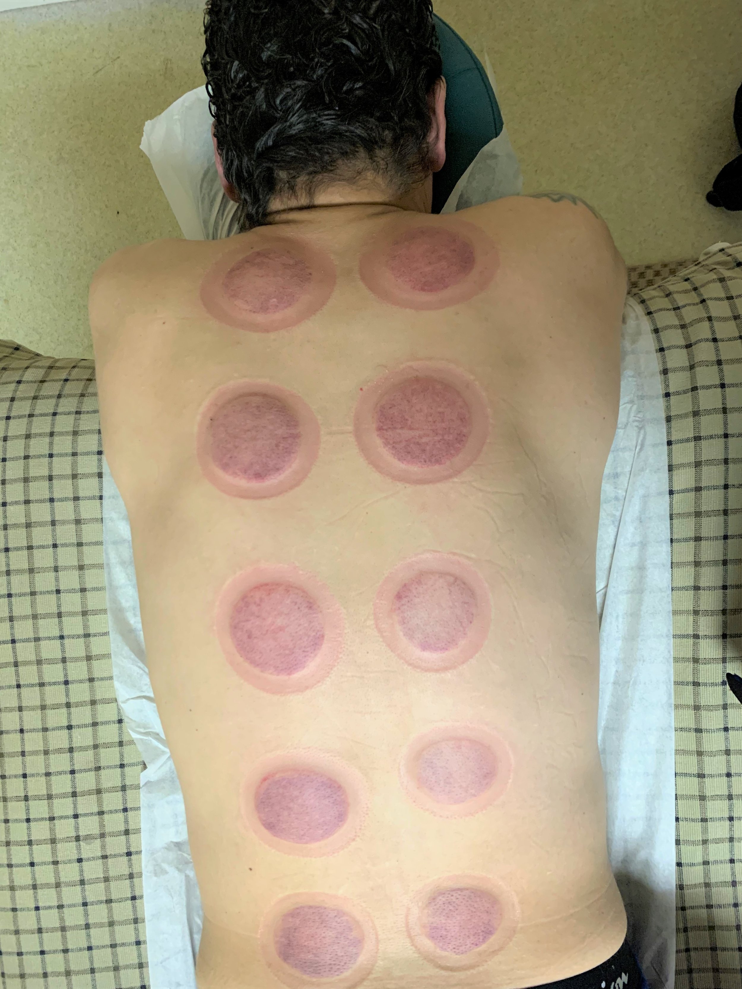 cupping 1.jpg