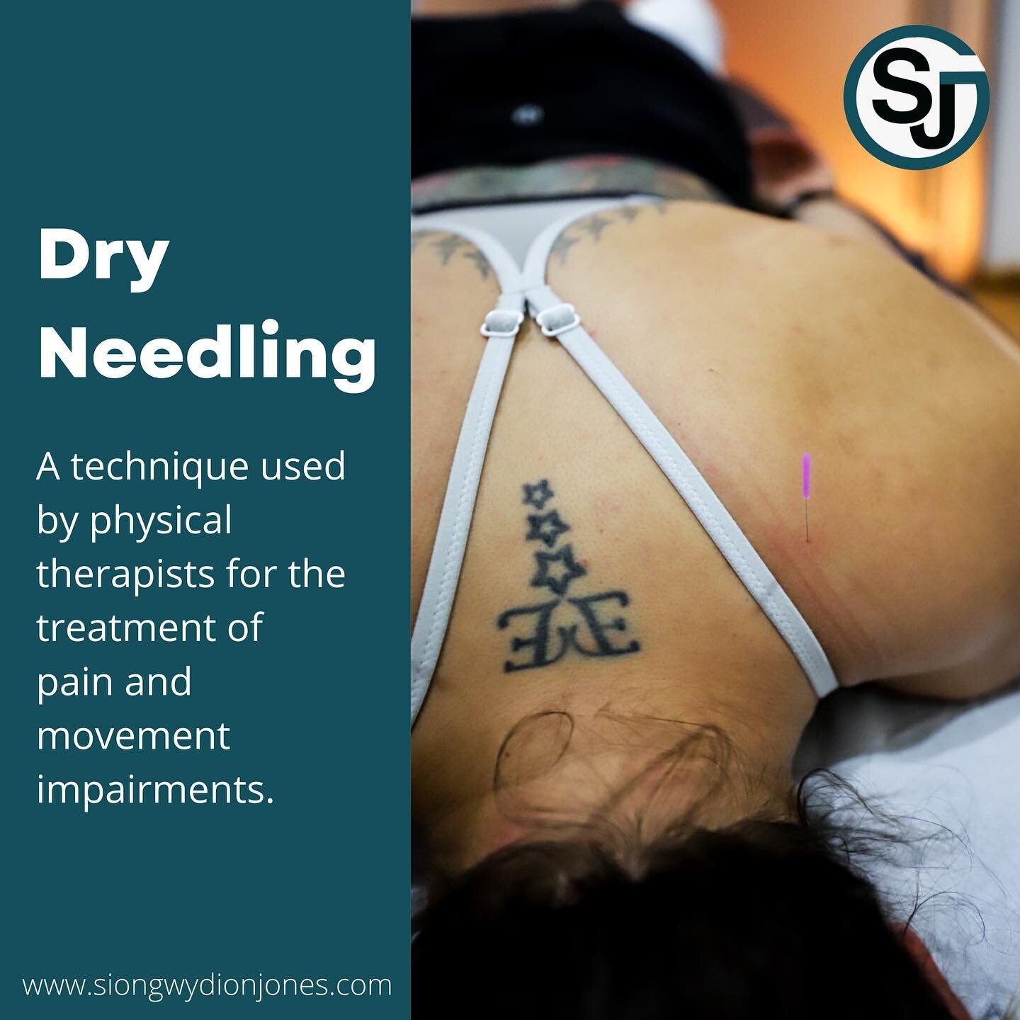 The main benefit of dry needling is pain relief for muscular pain and stiffness. But increase of range of motion and flexibility is common, hence why I use it frequently to treat sports injuries, postoperative patients and even fibromyalgia pain. Dry