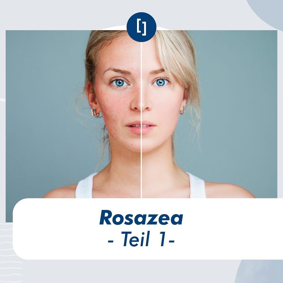 Rosazea &ndash; Teil 1

Wird Ihre Gesichtshaut manchmal rot und Sie wissen nicht warum?
Eine der Hauptursachen f&uuml;r Gesichtsr&ouml;tungen ist Rosazea.

Die R&ouml;tung wird durch eine Erweiterung der &Auml;derchen im Gesicht verursacht. 

Die Urs