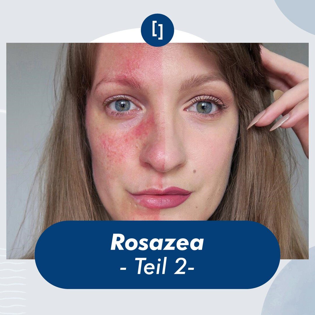 Rosazea - Teil 2 -

Die Behandlung von Rozasea:
Nicht Vergessen, dass Rozasea eine Chronische Erkrankung ist, die leider nicht abheilt.
Das Hauptziel besteht aber darin, die entz&uuml;ndliche komponente und die aktivit&auml;t der Blutgef&auml;&szlig;