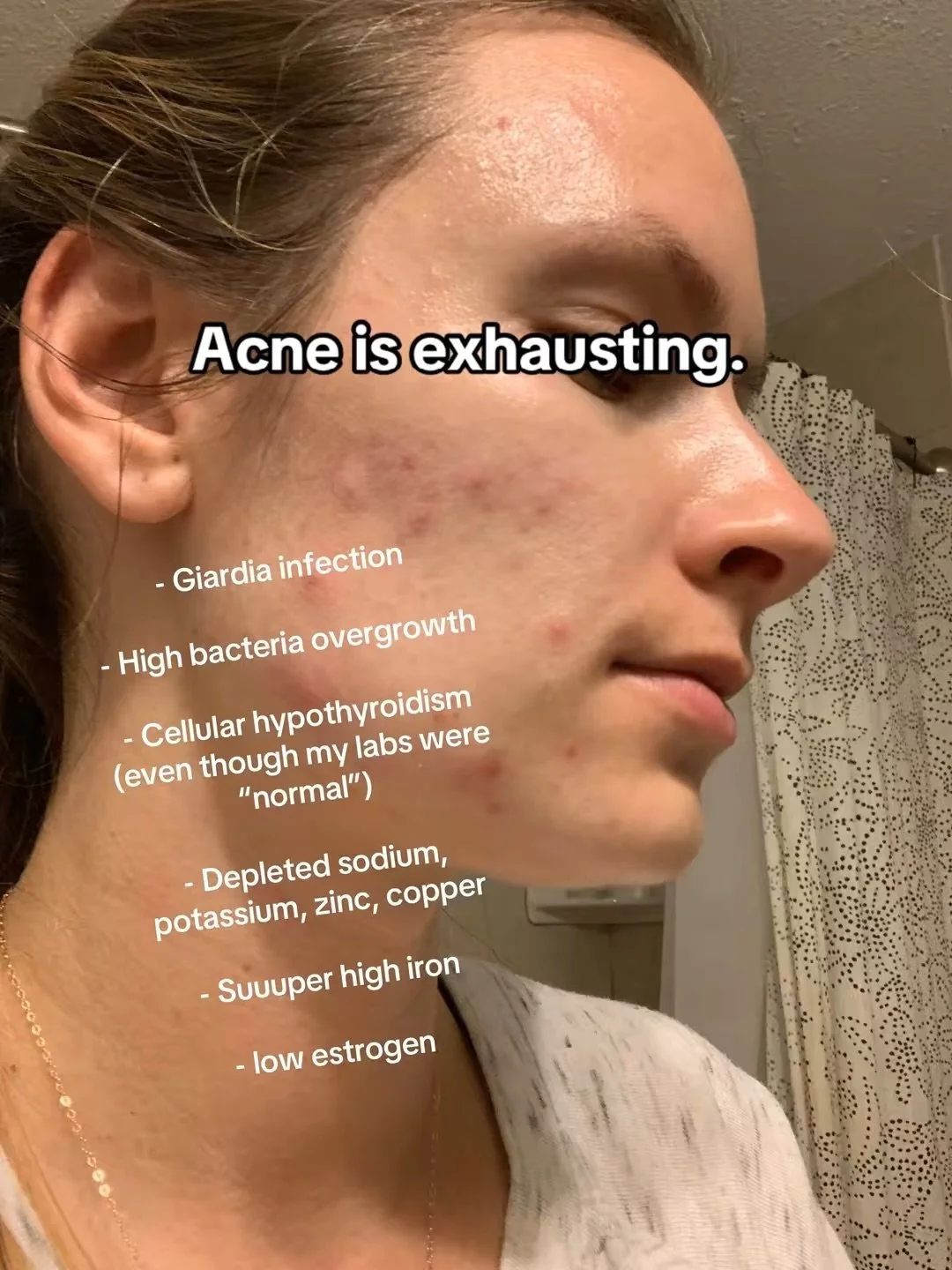 If you&rsquo;ve searched &ldquo;how to clear my acne&rdquo; a hundred times and nothing helps&hellip;there&rsquo;s usually something deeper going on than skincare.

It&rsquo;s not just about clean eating or cutting out dairy either. Breakouts that ke