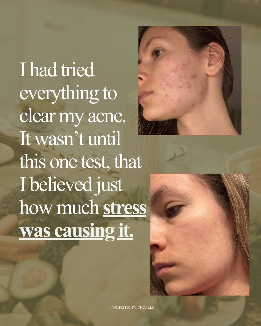 You can eat clean, avoid dairy and gluten, take zinc, take omega-3s, wash your pillow case every night but&hellip; 

If your nervous system is constantly in fight or flight and you aren&rsquo;t supporting your body through it? 

Your body will priori