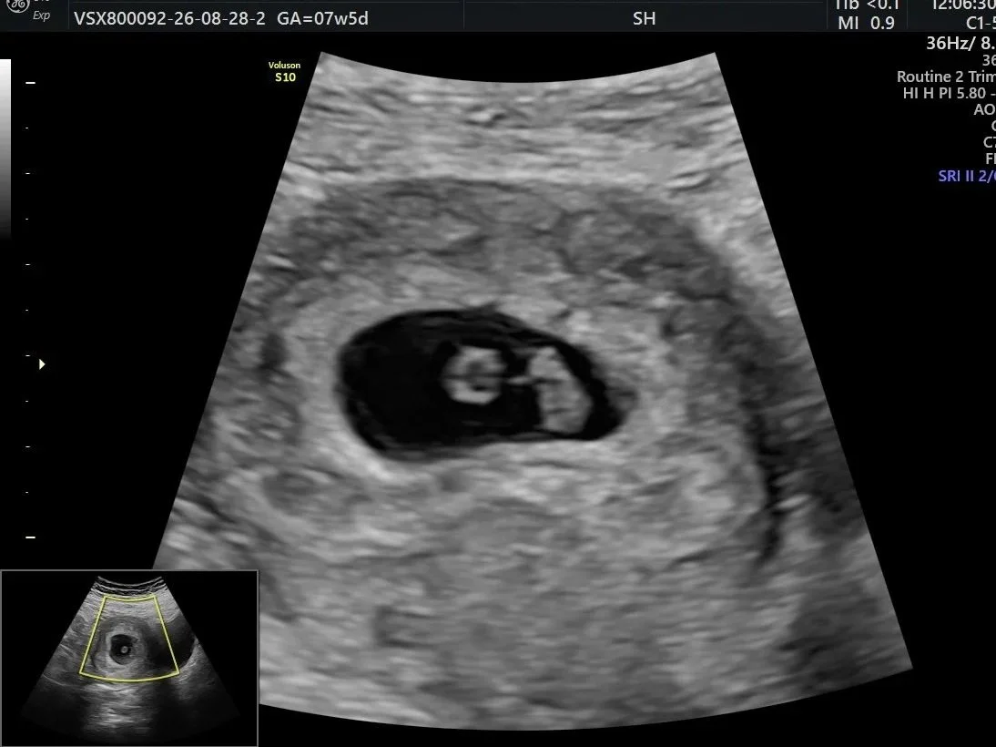 Dating Ultrasound